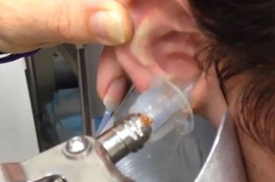 PICSITE EAR SYRINGING